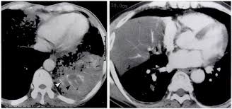 The most common signs of lung cancer are a cough that won't go away, chest pain, shortness of breath, weight loss, and fatigue. 9 8 Bronchioloalveolar Carcinoma With The Ct Angiogram Sign In A Download Scientific Diagram