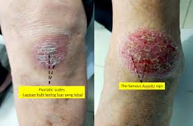 Image result for Auspitz Sign