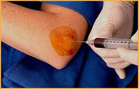 Image result for Epicondyle Injection