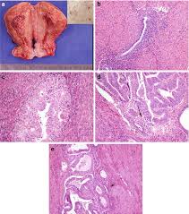 Below left is a sonogram of normal homogeneous myometrium. Diseases Of The Myometrium Springerlink