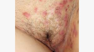 Image result for sore skin in the groin area