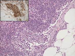 It level plodovnica po kapljicah sunday funday ex 2012 tarik phillips wvu scottish wool, per fisher. Lymph Node Pathology In Infectious Diseases Diagnostic Histopathology