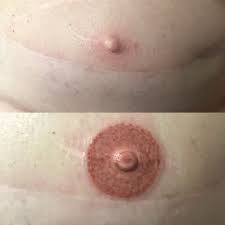 The cosmetic micropigmentation procedure involves embedding an organic pigment under the skin to add permanent colour, camouflaging the appearance of the stretch marks in ottawa patients. Paramedical And Scar Camouflage