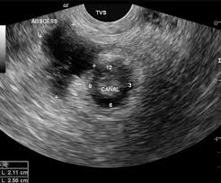 Image result for Perianal Abscess