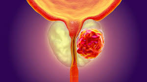 Incontinence after radical prostatectomy sucks. Prostate Cancer Lakeshore Cancer Center