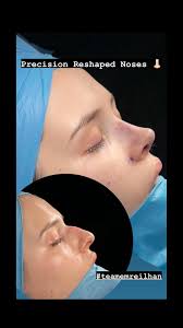 Rhinoplasty in Turkey