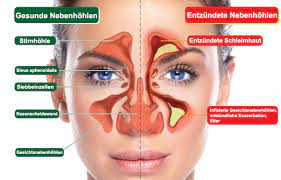 Warum Sind Nasensprays Und Antibiotika Bei Einer Sinusitis Unwirksam Gegenverstopftenase De
