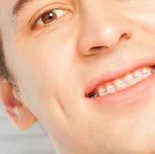 You might also need an interproximal reduction which removes teeth enamel to ensure you have enough space. Do Clear Braces Take Longer Than Other Teeth Straightening Treatments