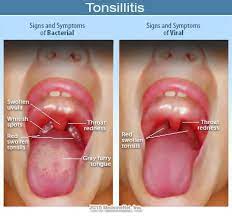 Tonsillitis and pharyngitis refer to the same type of infection. 14 Tonsillitis Symptoms Causes Treatment And Cure