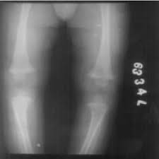 Human anatomy for muscle reproductive and skeleton. Showed Ground Glass Appearance Of Bone With Pencil Thin Cortex And Download Scientific Diagram