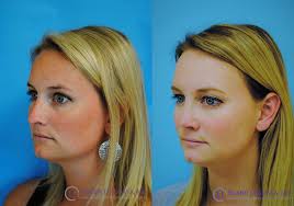 Rhinoplasty In 2020 Rhinoplasty Nose Surgery Human