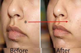 Tetapi tak jarang tahi lalat justru membuat seseorang tidak percaya diri dengan penampilannya. Cara Mudah Menghilangkan Tahi Lalat Yang Menganggu Secara Alami