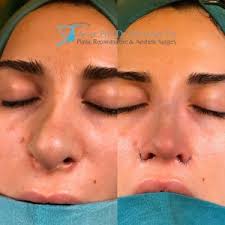 Thick Skin Nose Job Google Search Rhinoplasty Rhinoplasty Nose Jobs Nose Surgery Rhinoplasty