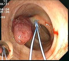 Beim entfernen von polypen (gutartigen wucherungen im darm) während einer darmspiegelung kann in seltenen fällen die darmwand verletzt werden. Darmpolypen Ursachen Beschwerden Diagnose Behandlung Prognose Vorbeugung Gesundmed Medizin Und Gesundheit Im Web