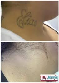 When you hurt yourself (stubbing your toe, for example), how would you rank the pain? Tattoo Pain Vs Laser Tattoo Removal Pain Medermis Laser Clinic