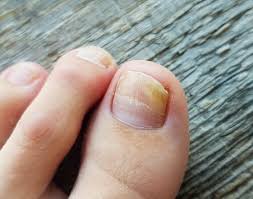 Image result for Koilonychia feet