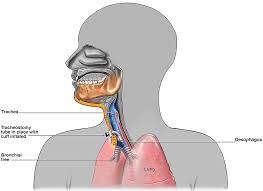 Image result for Tracheostomy