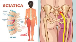 The lungs are two separate but connected organs located in the upper chest, covered by the rib cage. Sciatica A Pain In The Bum Literally Equilibrium Sports And Spinal Clinic