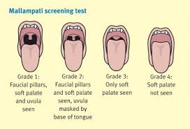 Posterior margin of the bony palate and the palatine aponeurosis. Tracheal Intubation Anaesthesia Intensive Care Medicine
