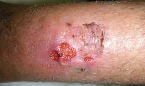 Image result for chancroid