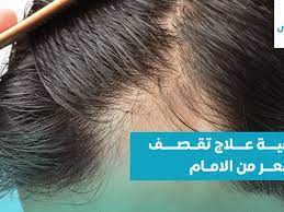 أسباب و كيفية علاج تقصف الشعر من الأمام نهائيا صحتي