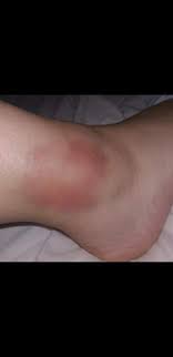 Umgeknickt, muss man zum arzt? Hilfe Was Ist Das Fur Eine Verletzung Gesundheit Und Medizin Knochel Umgeknickt