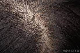 A bacteria can invade the ingrown hair cyst which can later leads to a discharge of either yellow or green in a more consistency way. What Is A Scalp Cyst With Pictures