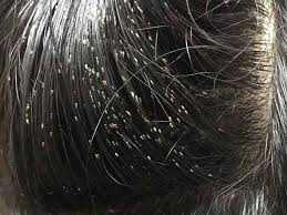 Check spelling or type a new query. How To Tell If You Have Lice Pay Attention To These 5 Signals