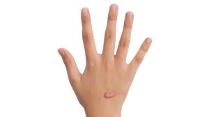 Verwandte anzeigen zu weleda narbensalbe. Wenn Narben Wuchern Dickes Ding Rbb