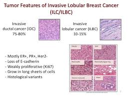 Pin Op Lobular Carcinoma