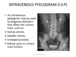 Image result for Intravenous Pyelogram