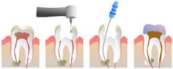 The chance of saving it is high. How Can A Dead Tooth Be Saved By A Dentist Muswell Hill Smile