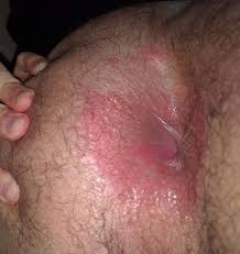 Image result for itchy skin rectum