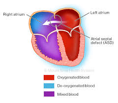 Image result for Atrial Septal Defect