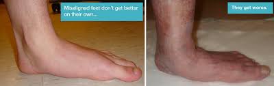 Haglund's syndrome encompasses several different pathologies, including haglund's deformity, insertional achilles tendonopathy, retrocalcaneal bursitis, and superficial bursitis. Stepping In The Right Direction Reston Fairfax Ashburn Mclean Va Podiatrists