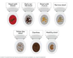 Image result for blood in stool human poop