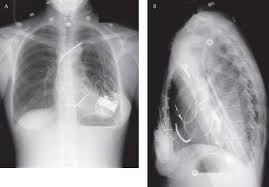 Implantable cardiac conduction devices (also known as cardiac implantable electronic devices or cieds) are a very common medical device of the thorax, with over one million implanted in the united states of america alone. Radiography Of Implantable Devices Thoracic Key