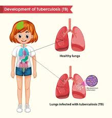 Tuberculosis is a bacterial infection that destroys patients' lung tissue. Urdufox An Authoritative Information Website