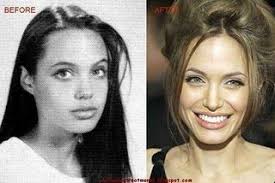Angelina Jolie Rhinoplasty Nose Job New Celebrity Angelina Jolie Nose Job Nose Job Rhinoplasty Nose Jobs