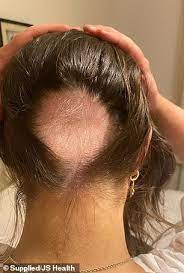 It has been proven to work and is available without a prescription. Woman Reveals How She Lost Her Hair Due To Stress And How Jshealth Vitamins Fixed Her Hair Australiannewsreview