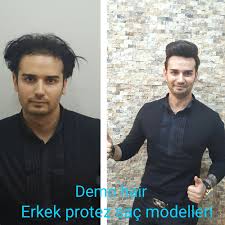 Erkekprotezsacmodelleri Protezsackullaniciyorumlari Protezsacyaptiranlar Protezsacsikayetleri Protezsac Sacprotezi Protezsac Pr Sac