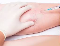 El dímero d es un tipo de proteína que producen los coágulos sanguíneos. Diagnostico Y Tratamiento Para La Trombosis
