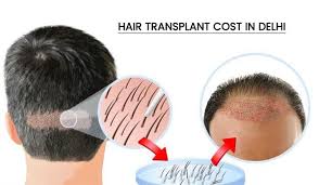 Yatmadan Once Bunu Icin Ve Her Gun Kilo Vererek Uyanin Netkadin Com Hair Transplant Cost Best Hair Transplant Fue Hair Transplant