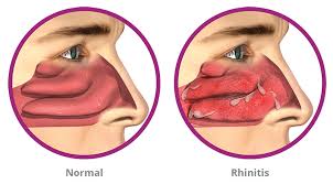 Image result for Allergic Rhinitis