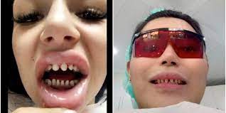 Know how to put veneers on broken tooth and more useful tips here. Tiktok Dentists Warn Against The Veneers Check Trend Paper
