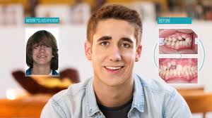 Profisil Fluoride Varnish is a game changer! No more fuzzy teeth or bad  taste for your patient! #fluoride #fluoridevarnish #dental #dentalhygiene