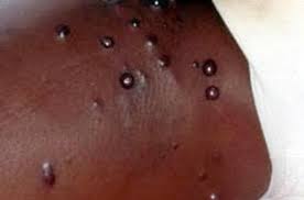 Image result for skin rash acute hiv infection