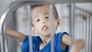 Agent Orange deformities: Dark side of Vietnam reveals cost of war