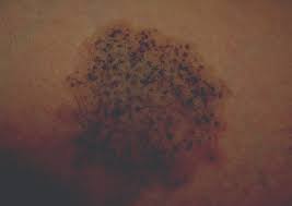 These birthmarks often grow in size for several months, and then gradually begin to fade. Nevus Spilus Is The Presence Of Hair Associated With An Increased Risk For Melanoma Mdedge Dermatology