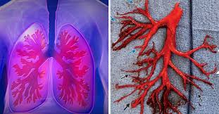 A pulmonary embolism often happens when part of the blood clot dislodges itself from your leg and travels up to your lungs, causing a blockage. Doctors Left Astonished After Man Coughs Up Enormous Blood Clot That Maps Out His Lungs